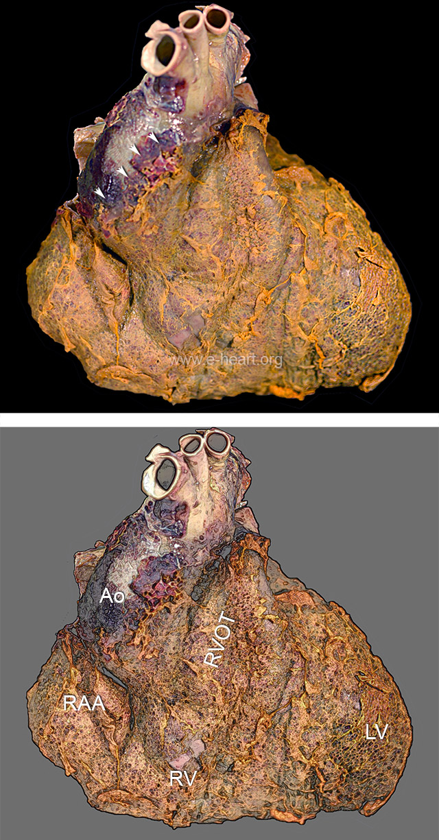 Fibrinous pericarditis
